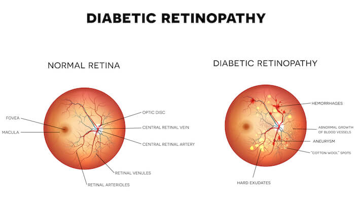 diagram of diabetic retinopathy
