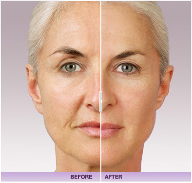Before and after of juvederm treatment
