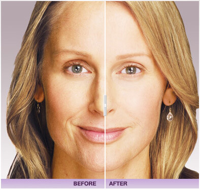 Before and after of juvederm treatment