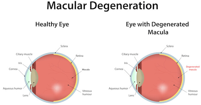 diagram of macular degeneration