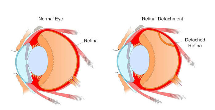 diagram of retinal detachment